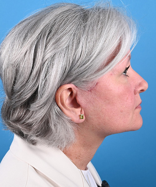 right side view after face and neck lift by Dr. Patel