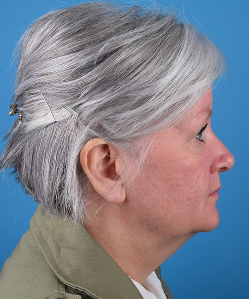 right side view before face and neck lift by Dr. Patel