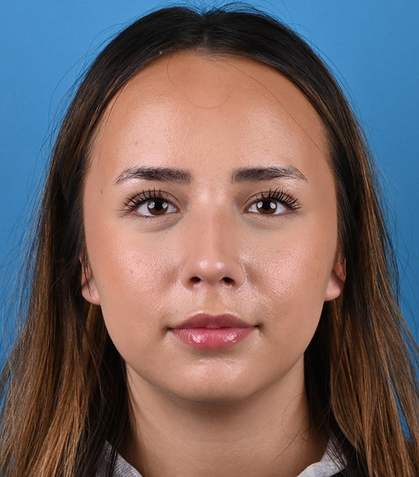 front view after rhinoplasty by Dr. Patel