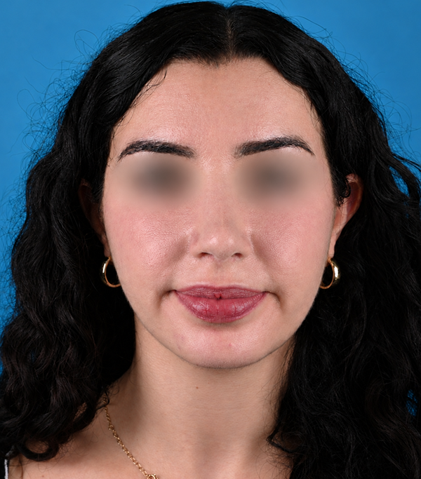 front view after rhinoplasty by Dr. Patel