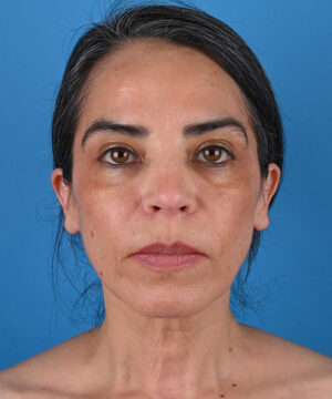 front view before face and neck lift by Dr. Patel front view before face and neck lift by Dr. Patel
