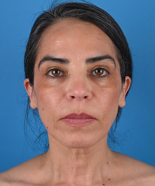front view before face and neck lift by Dr. Patel