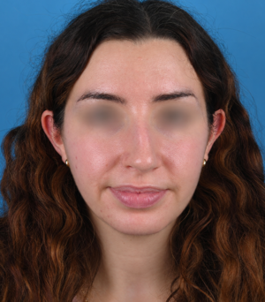 front view before rhinoplasty by Dr. Patel front view before rhinoplasty by Dr. Patel