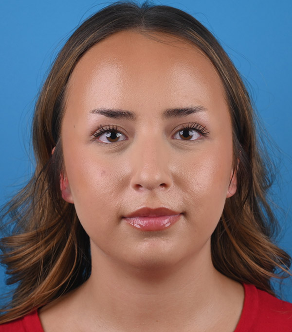 front view before rhinoplasty by Dr. Patel