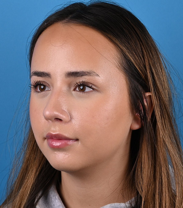 left oblique view after rhinoplasty by Dr. Patel