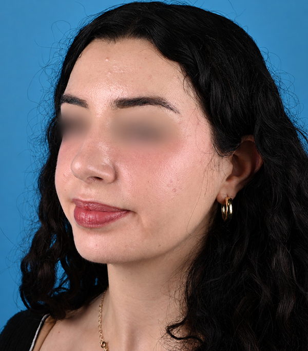 left oblique view after rhinoplasty by Dr. Patel