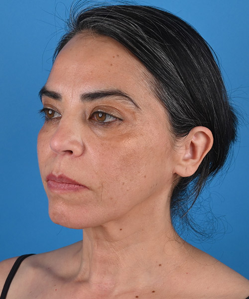 left oblique view before face and neck lift by Dr. Patel