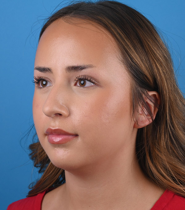 left oblique view before rhinoplasty by Dr. Patel