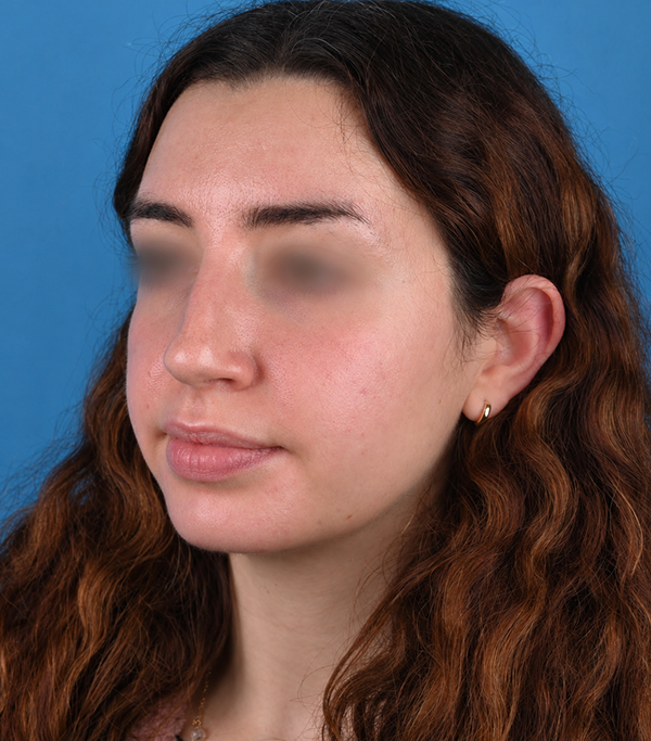 left oblique view before rhinoplasty by Dr. Patel