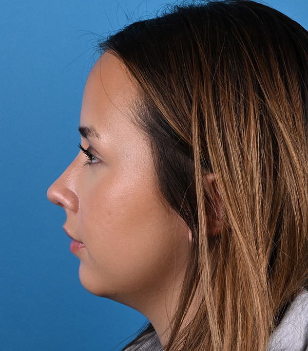 left side view after rhinoplasty by Dr. Patel