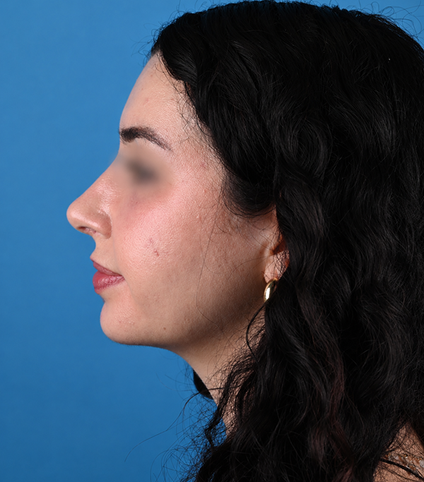 left side view after rhinoplasty by Dr. Patel