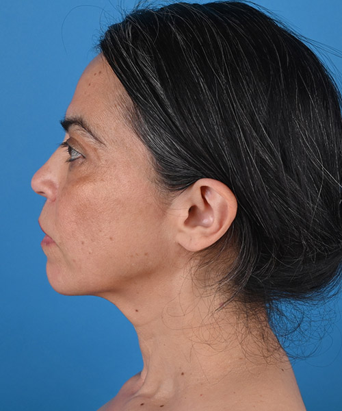 left side view before face and neck lift by Dr. Patel