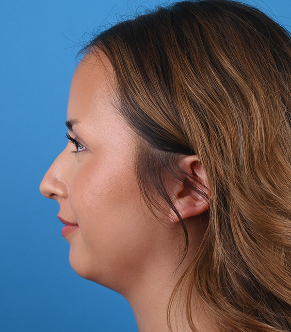 left side view before rhinoplasty by Dr. Patel