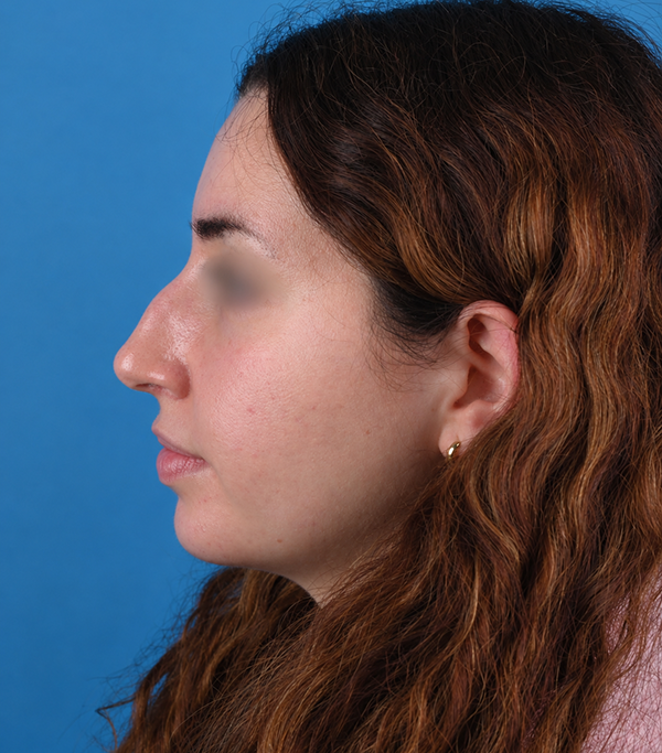 left side view before rhinoplasty by Dr. Patel