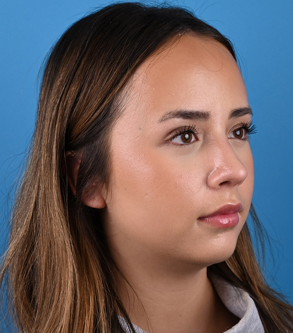 right oblique view after rhinoplasty by Dr. Patel