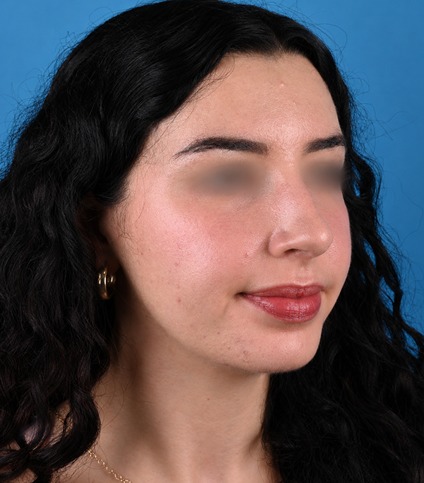 right oblique view after rhinoplasty by Dr. Patel