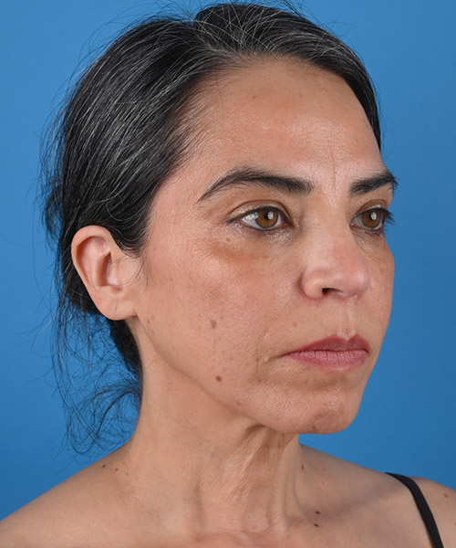 right oblique view before face and neck lift by Dr. Patel