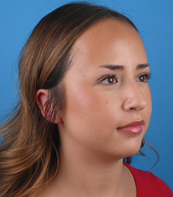 right oblique view before rhinoplasty by Dr. Patel