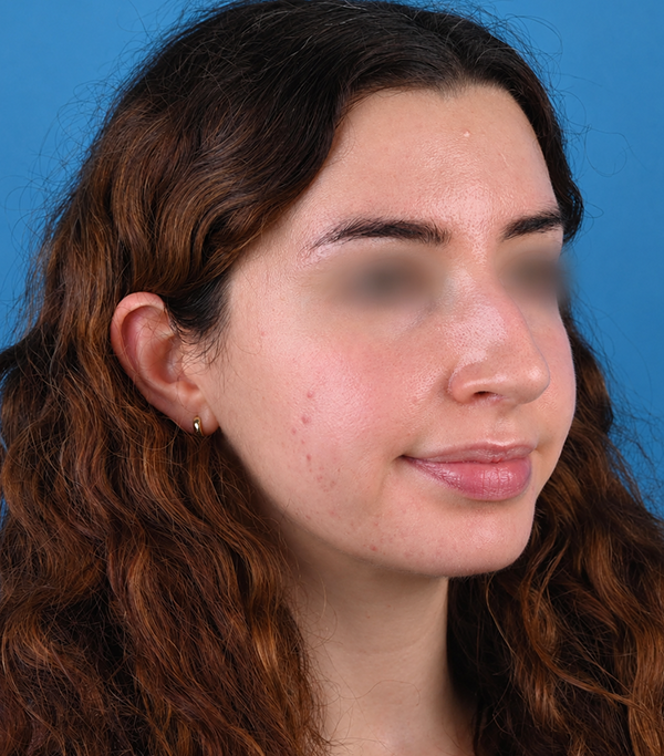right oblique view before rhinoplasty by Dr. Patel