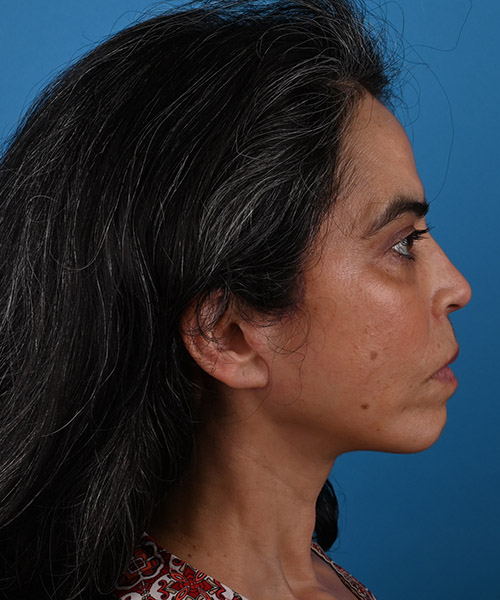 right side view after face and neck lift by Dr. Patel