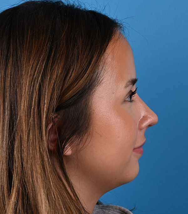 right side view after rhinoplasty by Dr. Patel