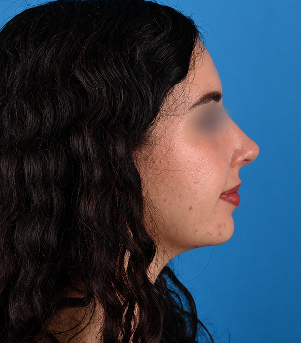 right side view after rhinoplasty by Dr. Patel