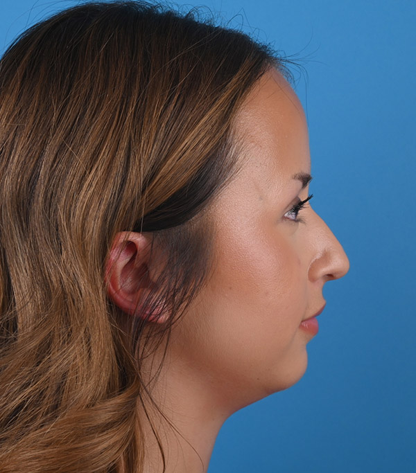 right side view before rhinoplasty by Dr. Patel