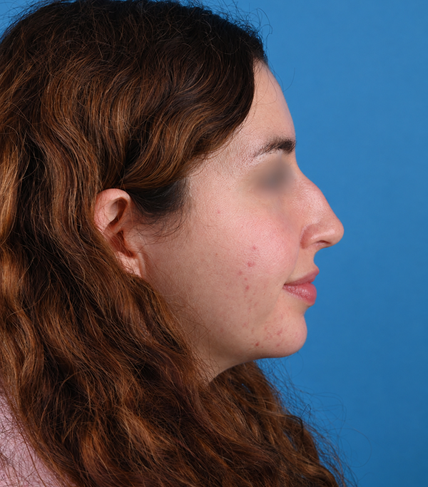 right side view before rhinoplasty by Dr. Patel