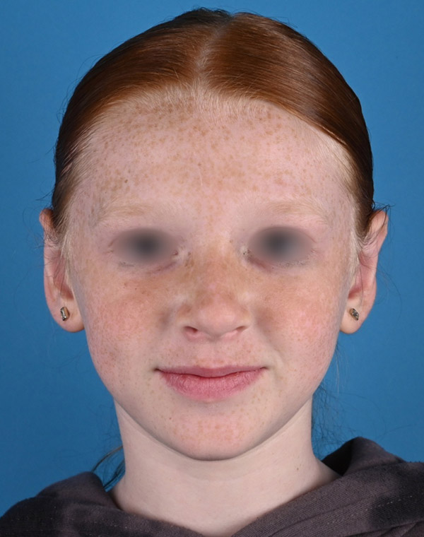 front view after otoplasty by Dr. Patel
