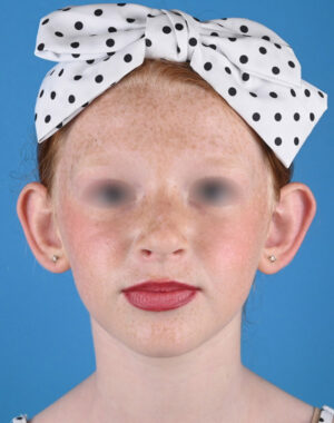 front view before otoplasty by Dr. Patel front view before otoplasty by Dr. Patel