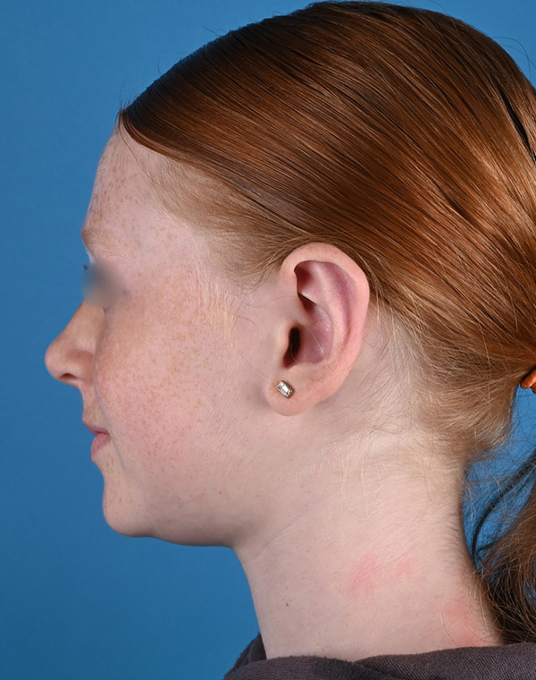 left side view after otoplasty by Dr. Patel