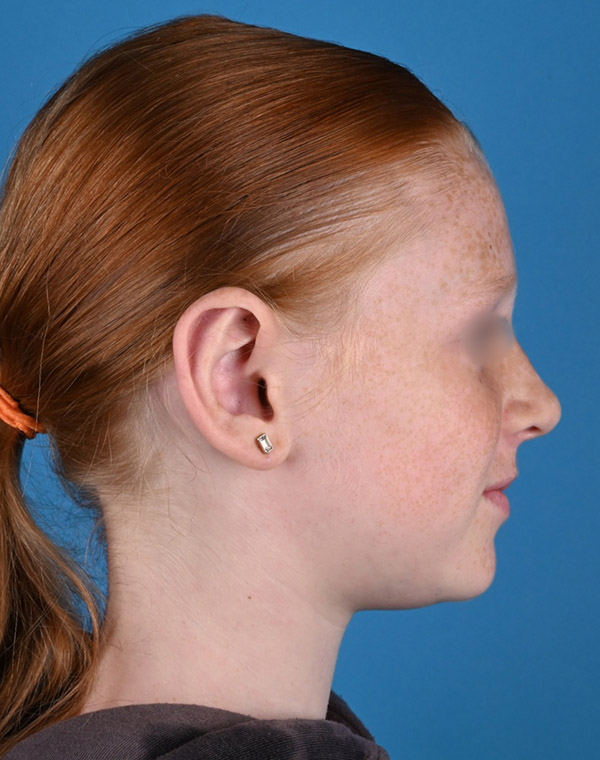 right side view after otoplasty by Dr. Patel