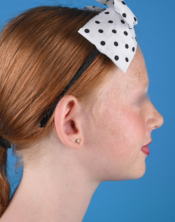 right side view before otoplasty by Dr. Patel